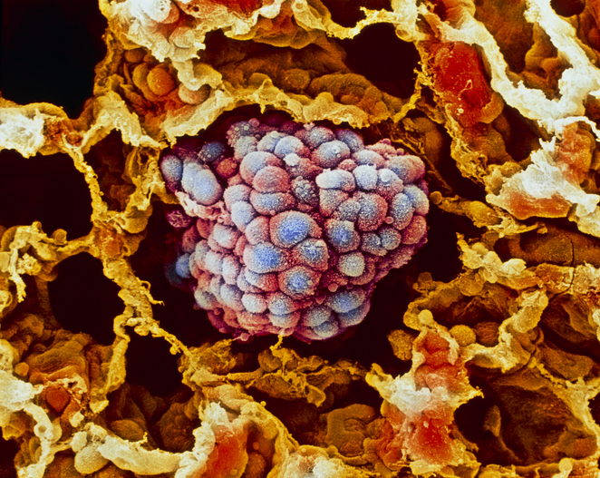 Image result for tissue-cancer