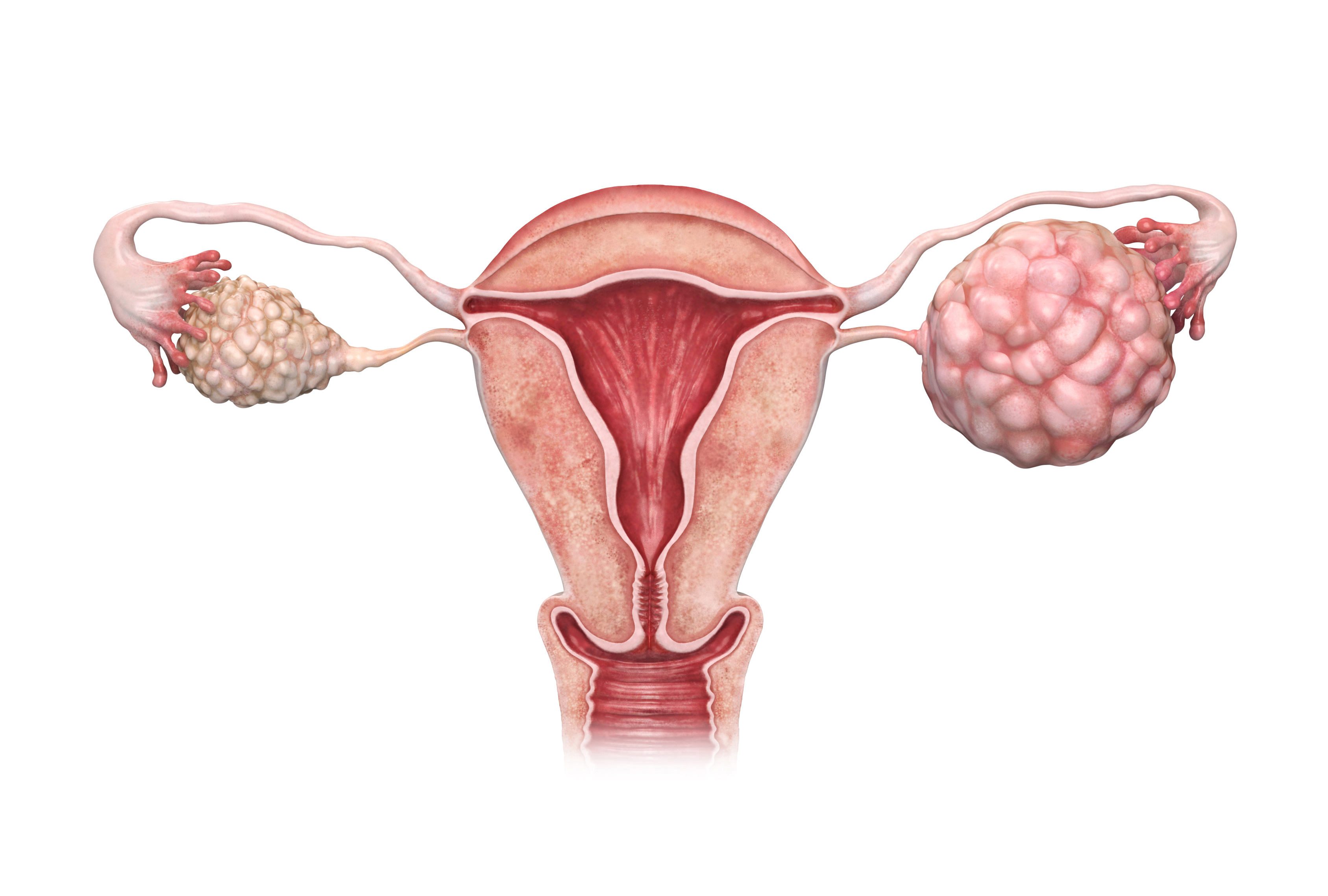Ovarian Cancer Cells' Dependence on Fat Suggests New Therapeutic Target