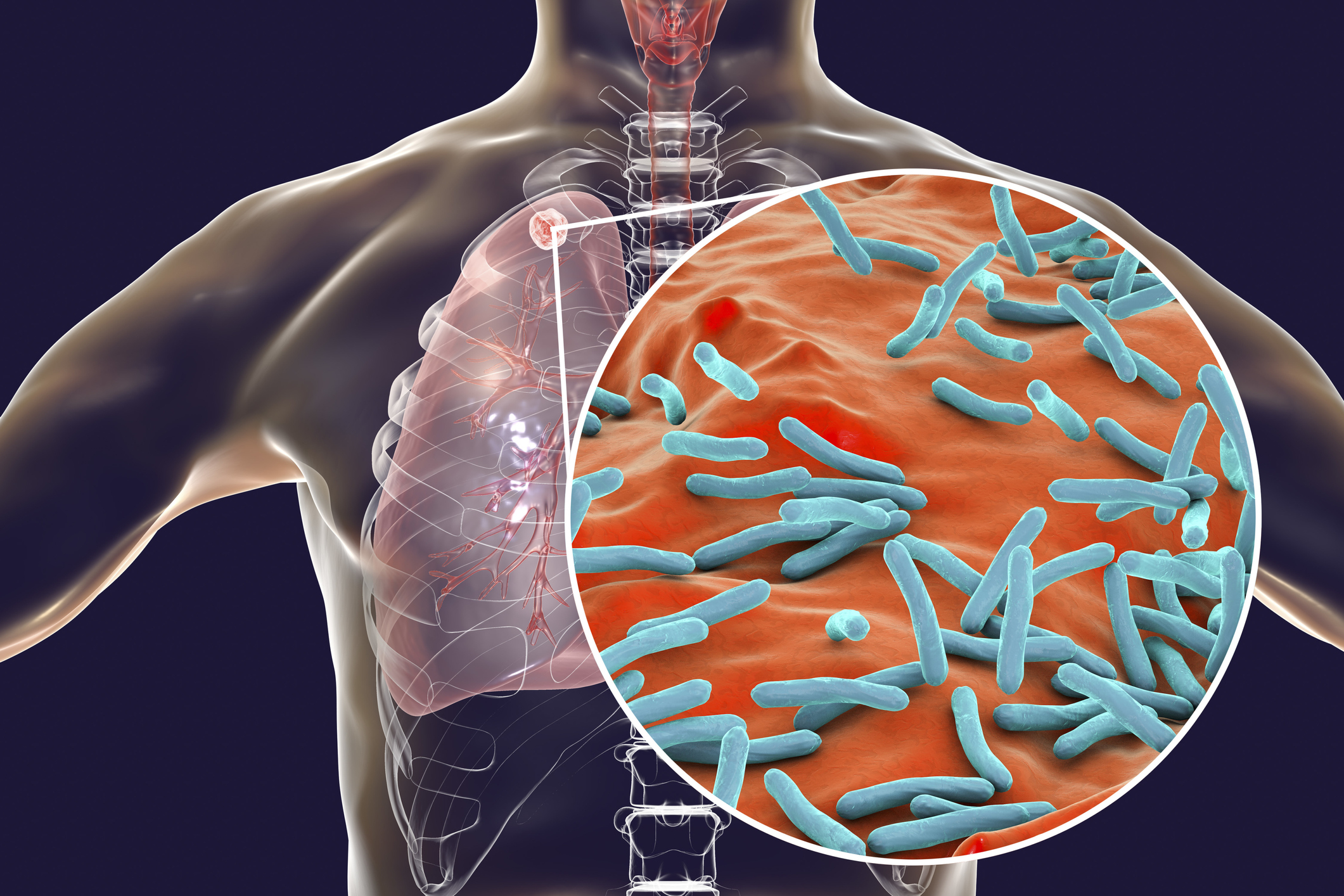 Genetic Targets for New Tuberculosis Lung Treatments Identified